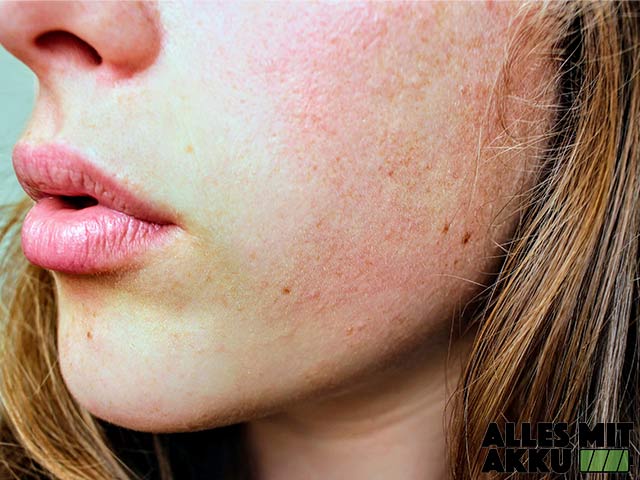 Eingewachsene Haare - Gesicht - Hautirritation